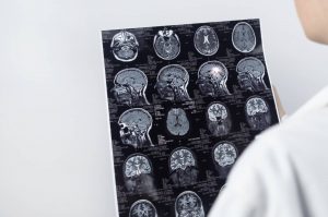 Does Medicare Cover Epilepsy