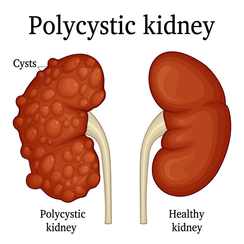 How does Medicare Cover Polycystic Kidney Disease